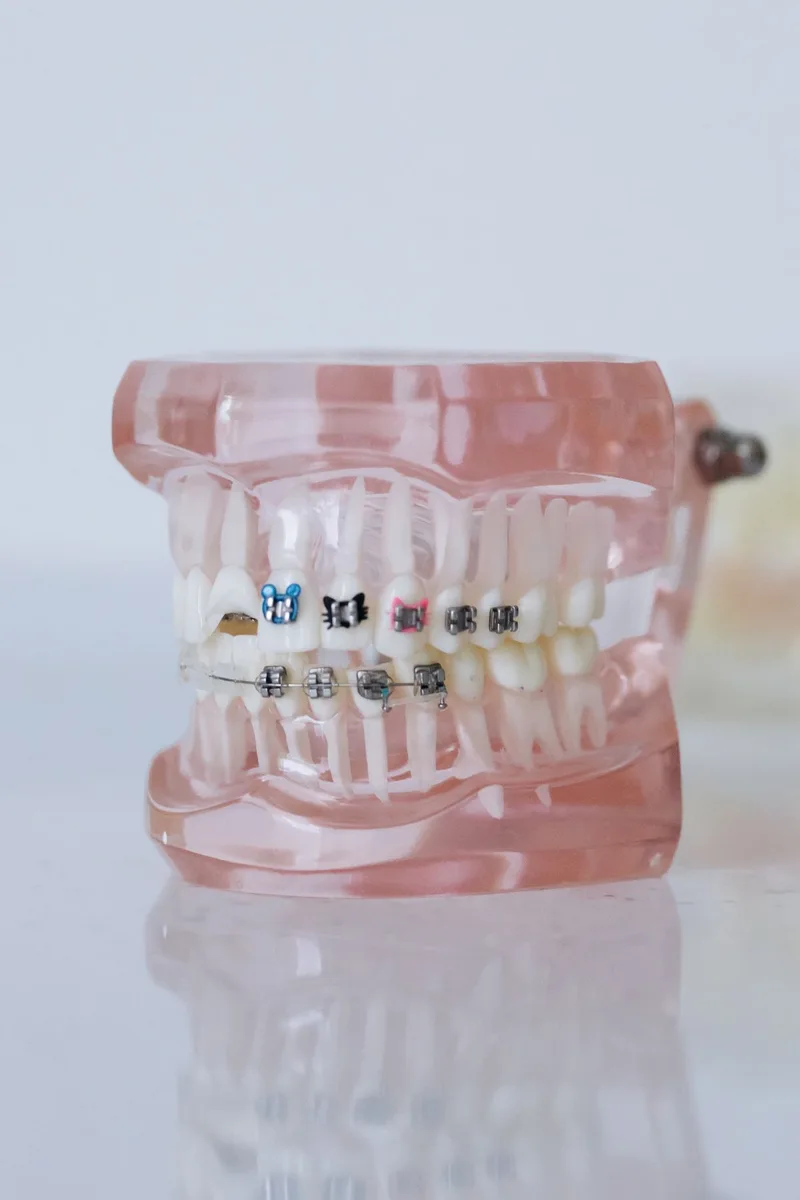 Modèle de dents avec appareil orthodontique